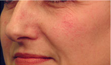Laser Vein Treatment