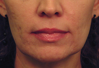 Yag Laser Skin Tightening 