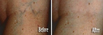Varicose vein treatment by laser