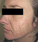 Acne Scar Removal 