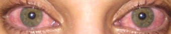IBRITE Eye Whitening