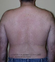 Laser Hair Removal