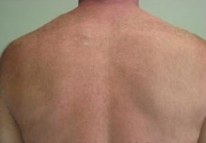 Laser Hair Removal for Back