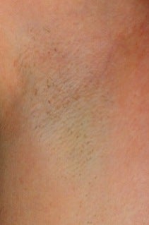 Laser hair removal for armpits