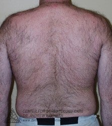 Laser Hair Removal