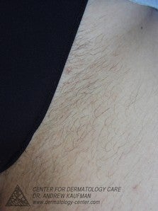 Laser Hair Removal to Bikini Area