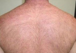 Laser Hair Removal for Back
