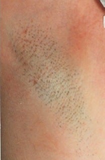 Laser hair removal for armpits