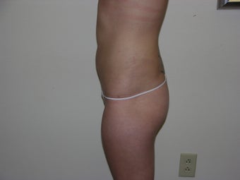 Liposuction