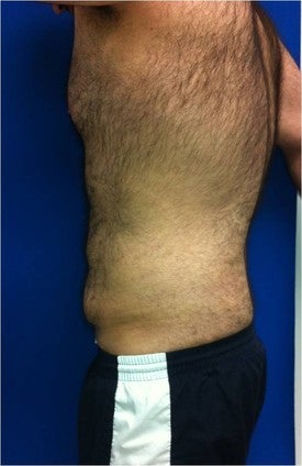 Laser Lipo
