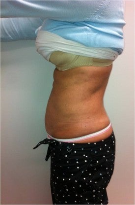 Laser Lipo