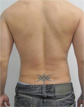 Laser Lipo