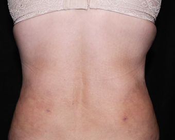 Laser Liposuction