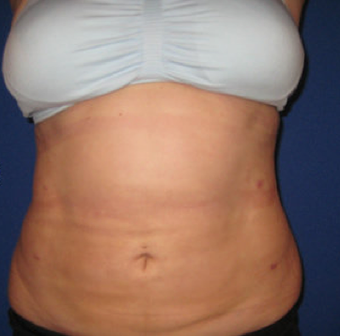 Laser Liposuction