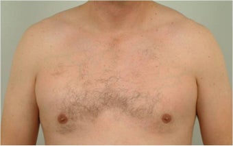Smart Lipo of the chest