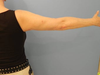 Laser Liposuction (Slim Lipo)