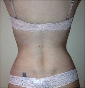 Laser Liposuction