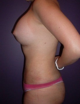 Laser Liposuction
