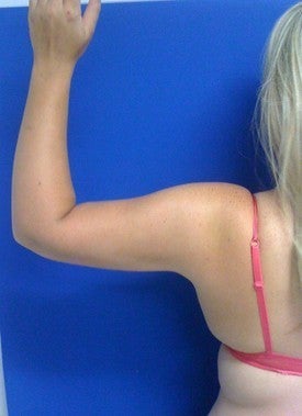 Laser Liposuction