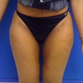 Laser Liposuction