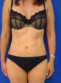 Laser Liposuction