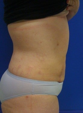 Laser Liposuction