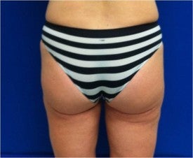 Laser Liposuction