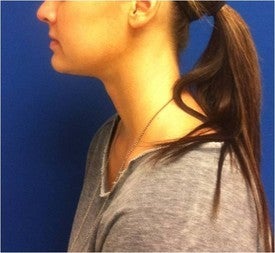Laser Liposuction
