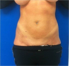 Laser Liposuction