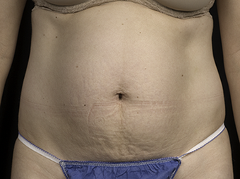 Laser liposuction