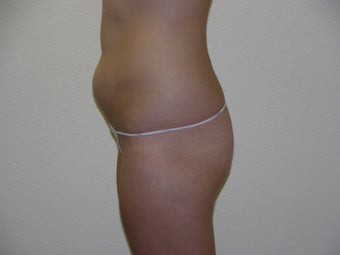 Liposuction