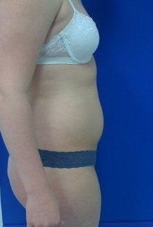 Laser Lipo