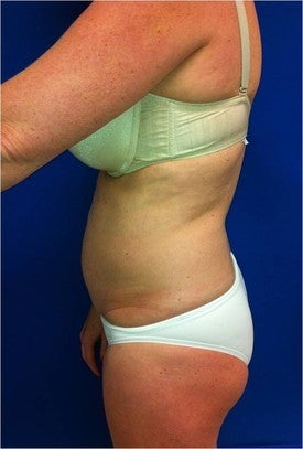 Laser Lipo