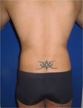 Laser Lipo