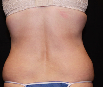 Laser Liposuction