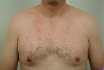 Smart Lipo of the chest