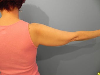 Laser Liposuction (Slim Lipo)