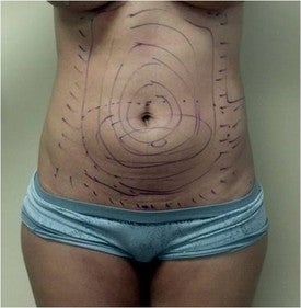 Laser Liposuction