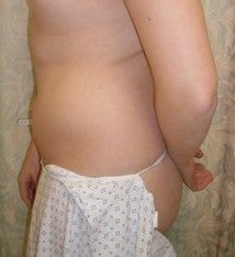 Laser Liposuction