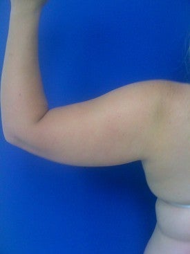 Laser Liposuction