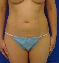 Laser Liposuction