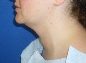 Laser Liposuction