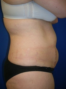 Laser Liposuction