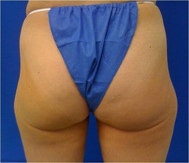 Laser Liposuction