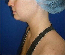 Laser Liposuction