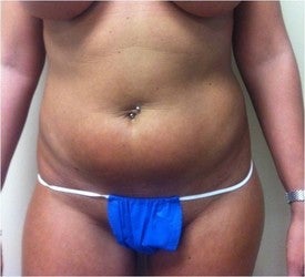 Laser Liposuction