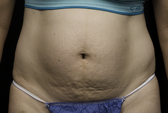 Laser liposuction