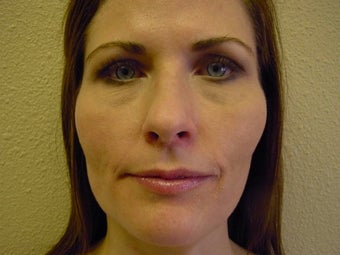 Microlaser Peels