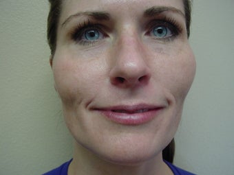 Microlaser Peels