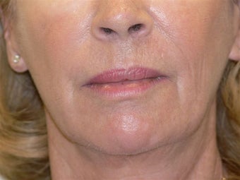 Laser resurfacing
